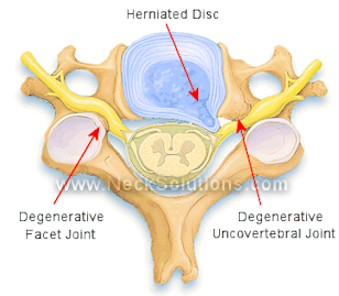 Degenerative Facet Joint and Uncovertebral Joint