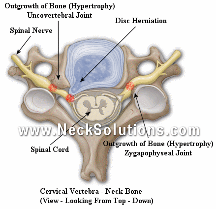 cervical radiculopathy