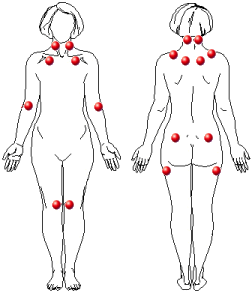 fibromyalgia tender points