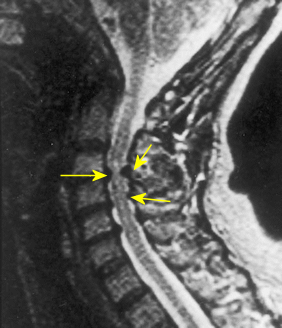 myelopathy