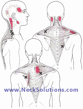 muscles affecting neck and shoulder pain