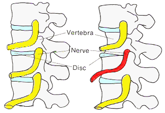 What are some symptoms of bad nerves?