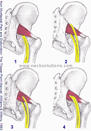 Piriformis Syndrome - Symptoms, Causes & Treatment