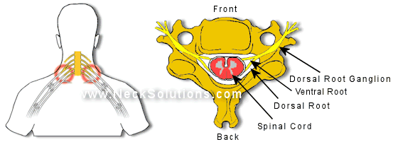 C4 Radiculopathy