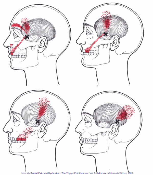 TMJ Pain & The Temporalis Muscle