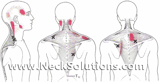 trapezius myalgia