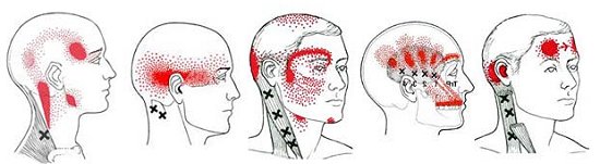 muscles related to headaches