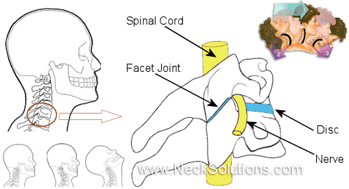 Whiplash Neck Pain