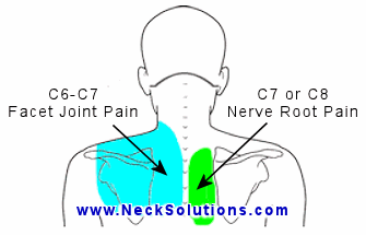 Causes of neck and shoulder pain after sleeping discount