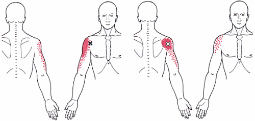 deltoid pain