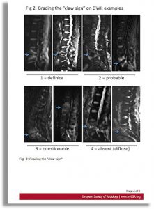 Modic Changes - Spinal Disease Or Normal Finding?