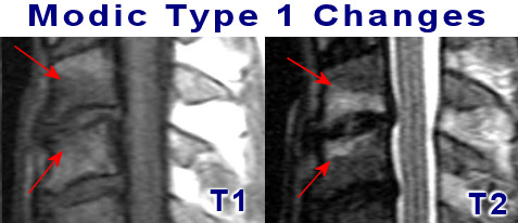 modic changes type 1 cervical