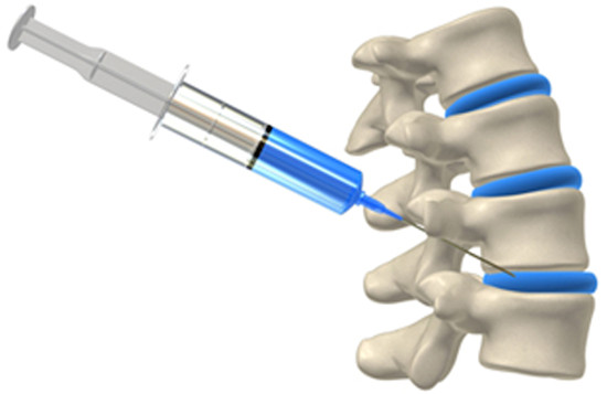 spinal injections