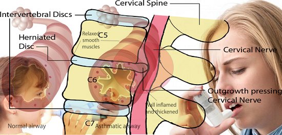 asthma associated with disc disease and herniations