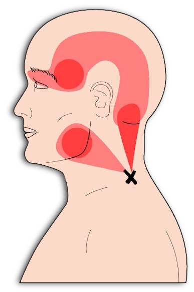 trigger points