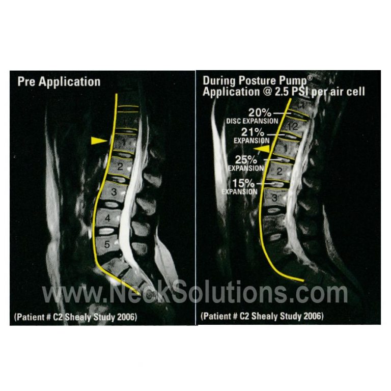 Home Back Traction Therapy For A Healthy Back