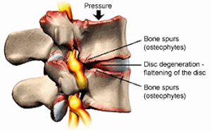 Cervical Degenerative Disc Disease & Mechanical Neck Pain