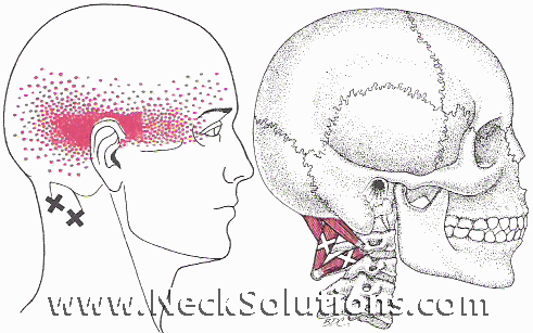 suboccipital muscles