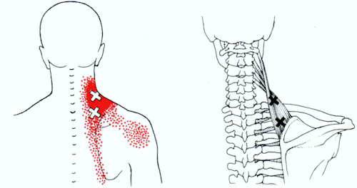 neck strain - levator scapula