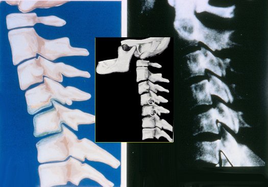 Neck Arthritis , Progressive Degeneration \u0026 How To Stop It