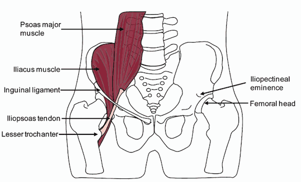 psoas syndrome