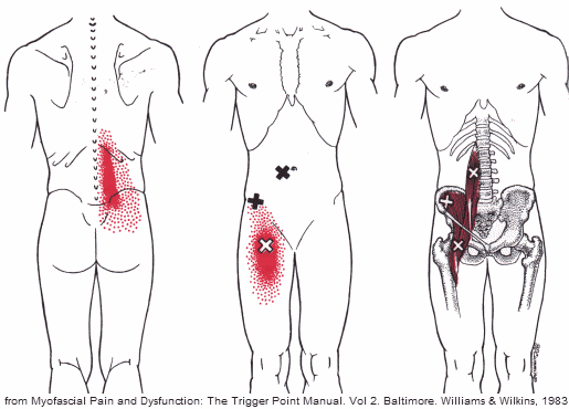 Psoas Syndrome - Overlooked Cause Of Back, Hip & Groin Pain