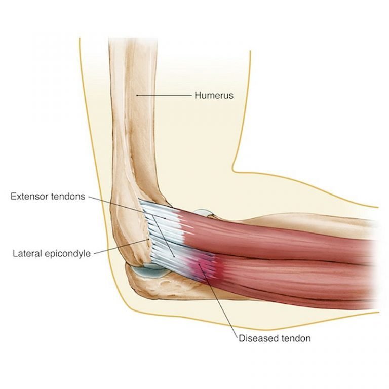 Elbow Pain - Causes & Treatments For Tennis Elbow