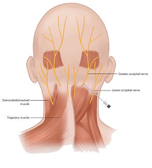 occipital neuralgia headache