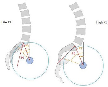 loss of lumbar curve