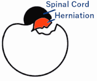 upper back disc herniation