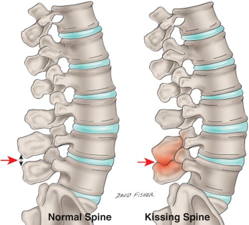 kissing spine