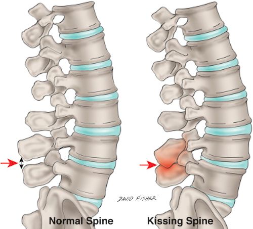 kissing spine