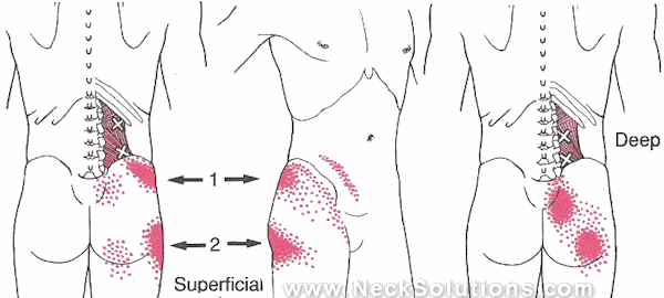 back strain in quadratus muscle